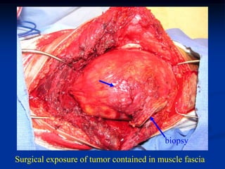 biopsy

Surgical exposure of tumor contained in muscle fascia
 