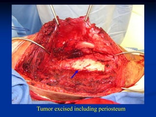 Tumor excised including periosteum
 