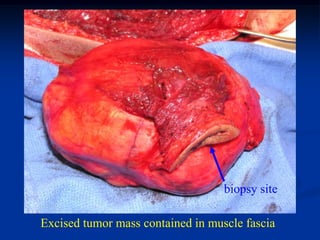 biopsy site

Excised tumor mass contained in muscle fascia
 