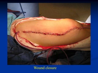 Wound closure
 