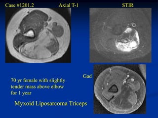 Case #1201.2            Axial T-1         STIR




                                    Gad
  70 yr female with slightly
  tender mass above elbow
  for 1 year

   Myxoid Liposarcoma Triceps
 