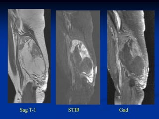 Sag T-1   STIR   Gad
 