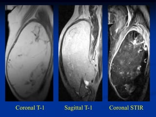 Coronal T-1   Sagittal T-1   Coronal STIR
 