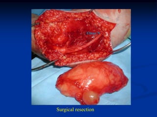 Ulnar N




Surgical resection
 