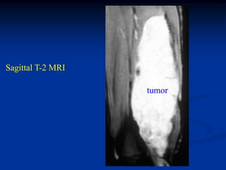 Sagittal T-2 MRI

                   tumor
 