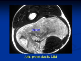 tumor




Axial proton density MRI
 