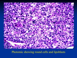 Photomic showing round cells and lipoblasts
 