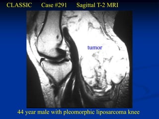 CLASSIC   Case #291     Sagittal T-2 MRI




                            tumor




  44 year male with pleomorphic liposarcoma knee
 