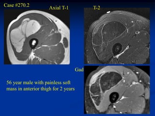 Case #270.2           Axial T-1             T-2




                                      Gad

 56 year male with painless soft
 mass in anterior thigh for 2 years
 