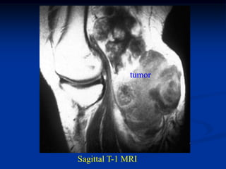 tumor




Sagittal T-1 MRI
 