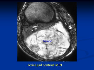 tumor




Axial gad contrast MRI
 