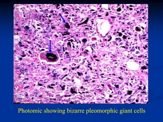 Photomic showing bizarre pleomorphic giant cells
 