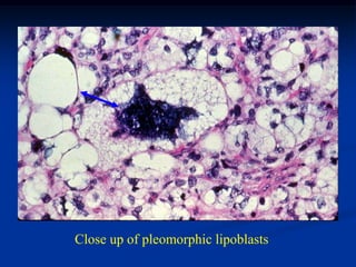Close up of pleomorphic lipoblasts
 