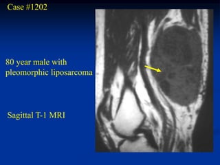 Case #1202




80 year male with
pleomorphic liposarcoma




Sagittal T-1 MRI
 