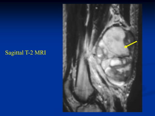 Sagittal T-2 MRI
 
