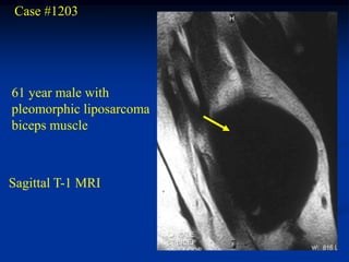 Case #1203




61 year male with
pleomorphic liposarcoma
biceps muscle



Sagittal T-1 MRI
 