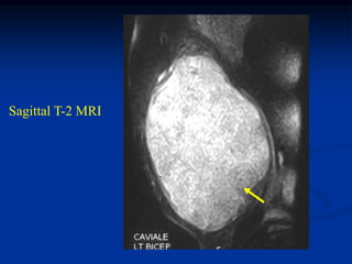 Sagittal T-2 MRI
 