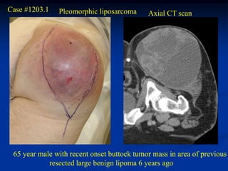Case #1203.1   Pleomorphic liposarcoma      Axial CT scan




 65 year male with recent onset buttock tumor mass in area of previous
            resected large benign lipoma 6 years ago
 