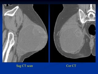 Sag CT scan   Cor CT
 