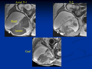 Axial T-1     T-2




fluid


   tumor




           Gad
 