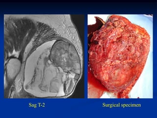 Sag T-2   Surgical specimen
 