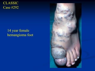 CLASSIC
Case #292




  14 year female
  hemangioma foot
 