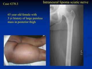 Case #270.3                         Intraneural lipoma sciatic nerve


   65 year old female with
   3 yr history of large painless
   mass in posterior thigh
 