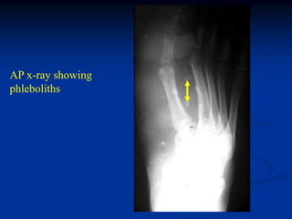 AP x-ray showing
phleboliths
 
