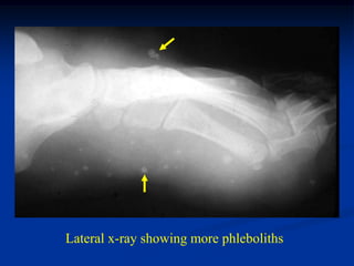 Lateral x-ray showing more phleboliths
 