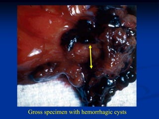 Gross specimen with hemorrhagic cysts
 