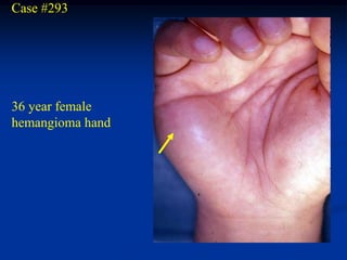 Case #293




36 year female
hemangioma hand
 