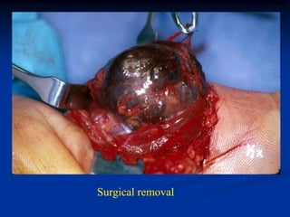 Surgical removal
 