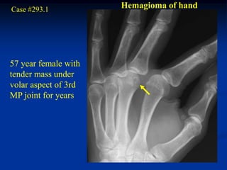 Case #293.1           Hemagioma of hand




57 year female with
tender mass under
volar aspect of 3rd
MP joint for years
 