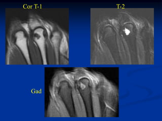 Cor T-1   T-2




  Gad
 