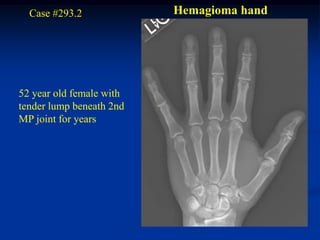 Case #293.2             Hemagioma hand




52 year old female with
tender lump beneath 2nd
MP joint for years
 