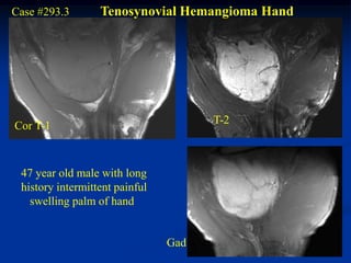 Case #293.3       Tenosynovial Hemangioma Hand




                                      T-2
Cor T-1



 47 year old male with long
 history intermittent painful
   swelling palm of hand


                                Gad
 