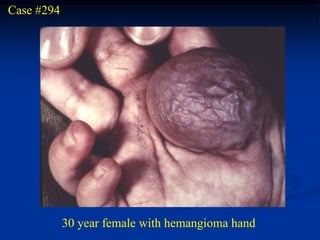 Case #294




            30 year female with hemangioma hand
 
