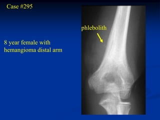 Case #295


                        phlebolith

8 year female with
hemangioma distal arm
 