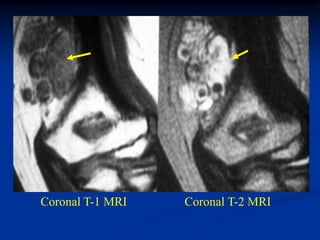 Coronal T-1 MRI   Coronal T-2 MRI
 