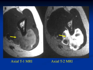 Axial T-1 MRI   Axial T-2 MRI
 
