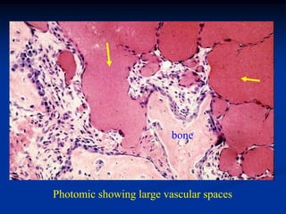 bone




Photomic showing large vascular spaces
 