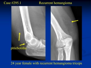 Case #295.1           Recurrent hemangioma




    phleboliths



    24 year female with recurrent hemangioma triceps
 