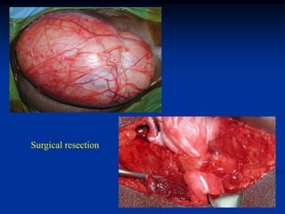 Surgical resection
 