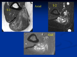 Axial     T-2
T-1




              Gad
 