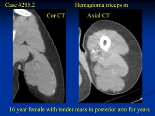 Case #295.2                 Hemagioma triceps m
                Cor CT           Axial CT




 16 year female with tender mass in posterior arm for years
 