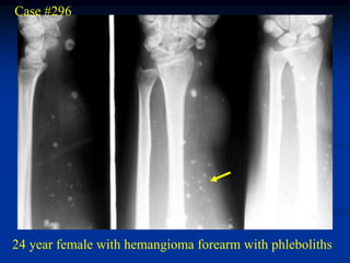 Case #296




24 year female with hemangioma forearm with phleboliths
 