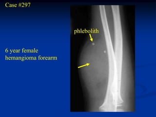 Case #297



                     phlebolith


6 year female
hemangioma forearm
 