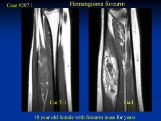 Case #297.1                    Hemangioma forearm




                     Cor T-1                          Gad

              18 year old female with forearm mass for years
 