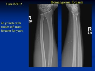 Case #297.2     Hemangioma forearm




46 yr male with
tender soft mass
forearm for years
 