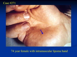 Case #271




     74 year female with intramuscular lipoma hand
 